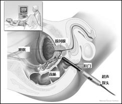 前列腺穿刺活检